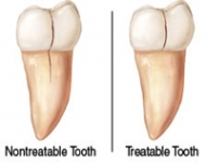Non-Treatable vs Treatable tooth