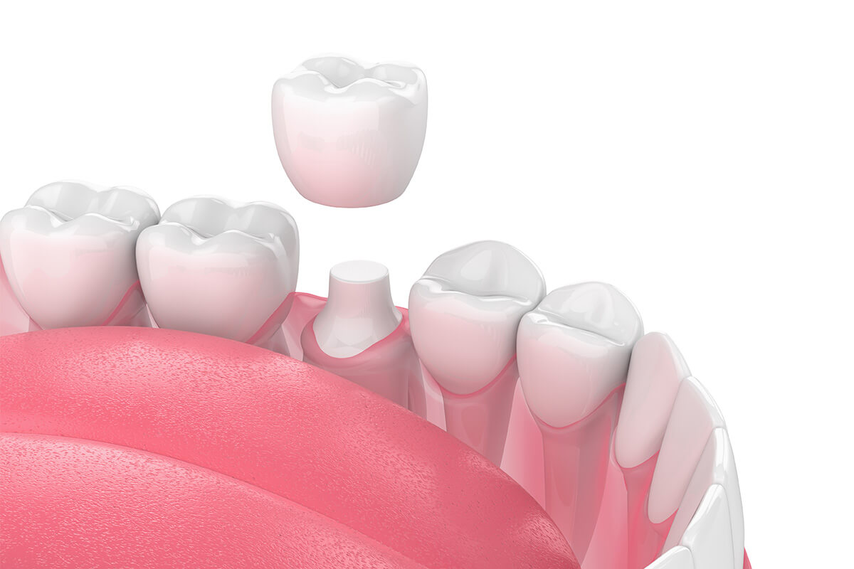 Cosmetic Dental Crowns in East Point GA Area