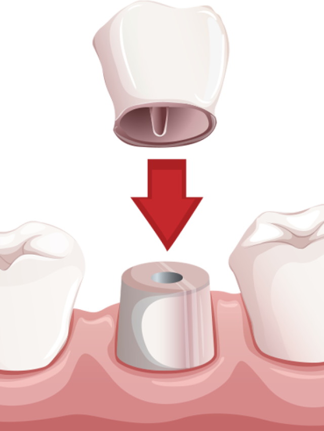 Cosmetic And Restorative Benefits Of Porcelain Crowns